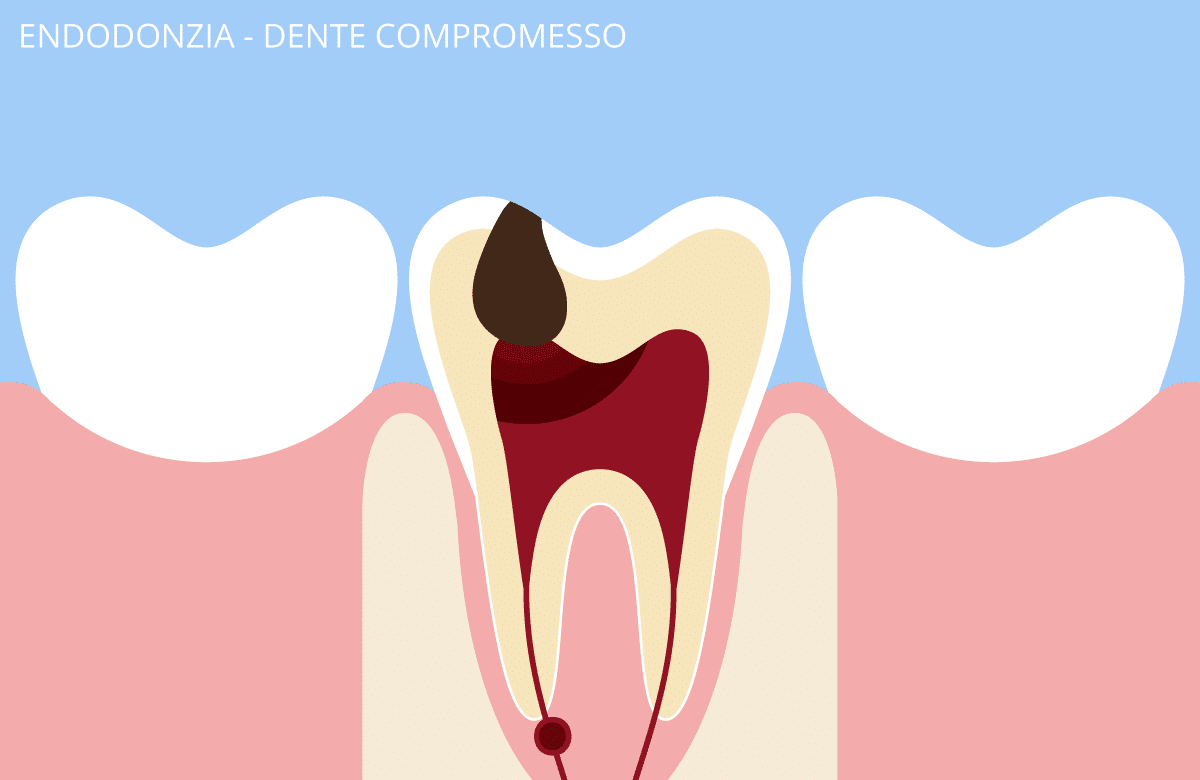 endodonzia_1