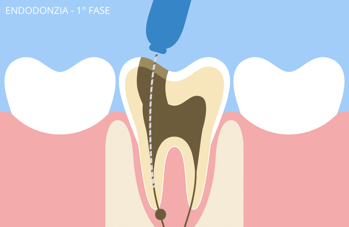 endodonzia_2