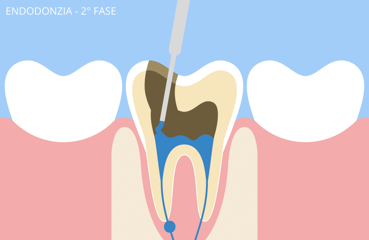 endodonzia_3