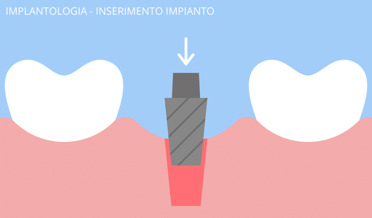 implantologia_1